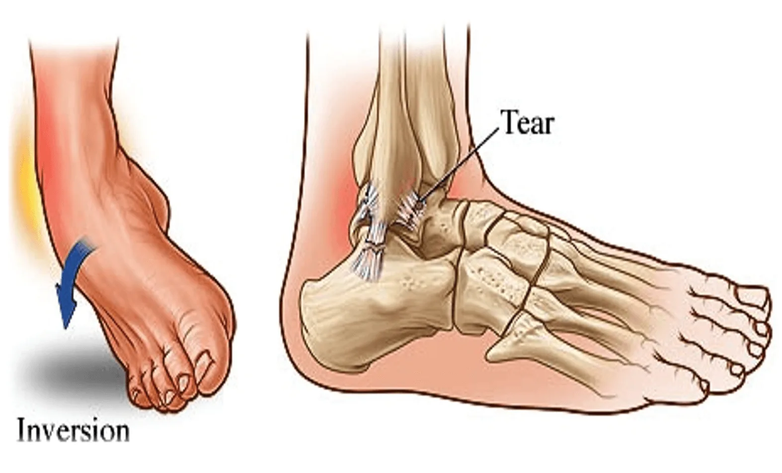 A Guide To Ankle Sprains Hurst Podiatry