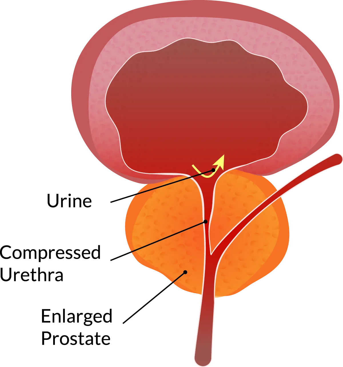 About Bph Causes Symptoms Treatments