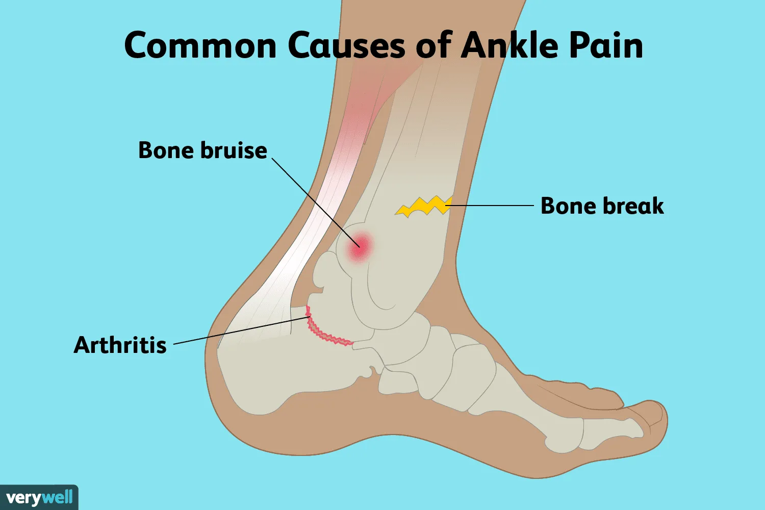 Ankle Pain Causes And Treatment