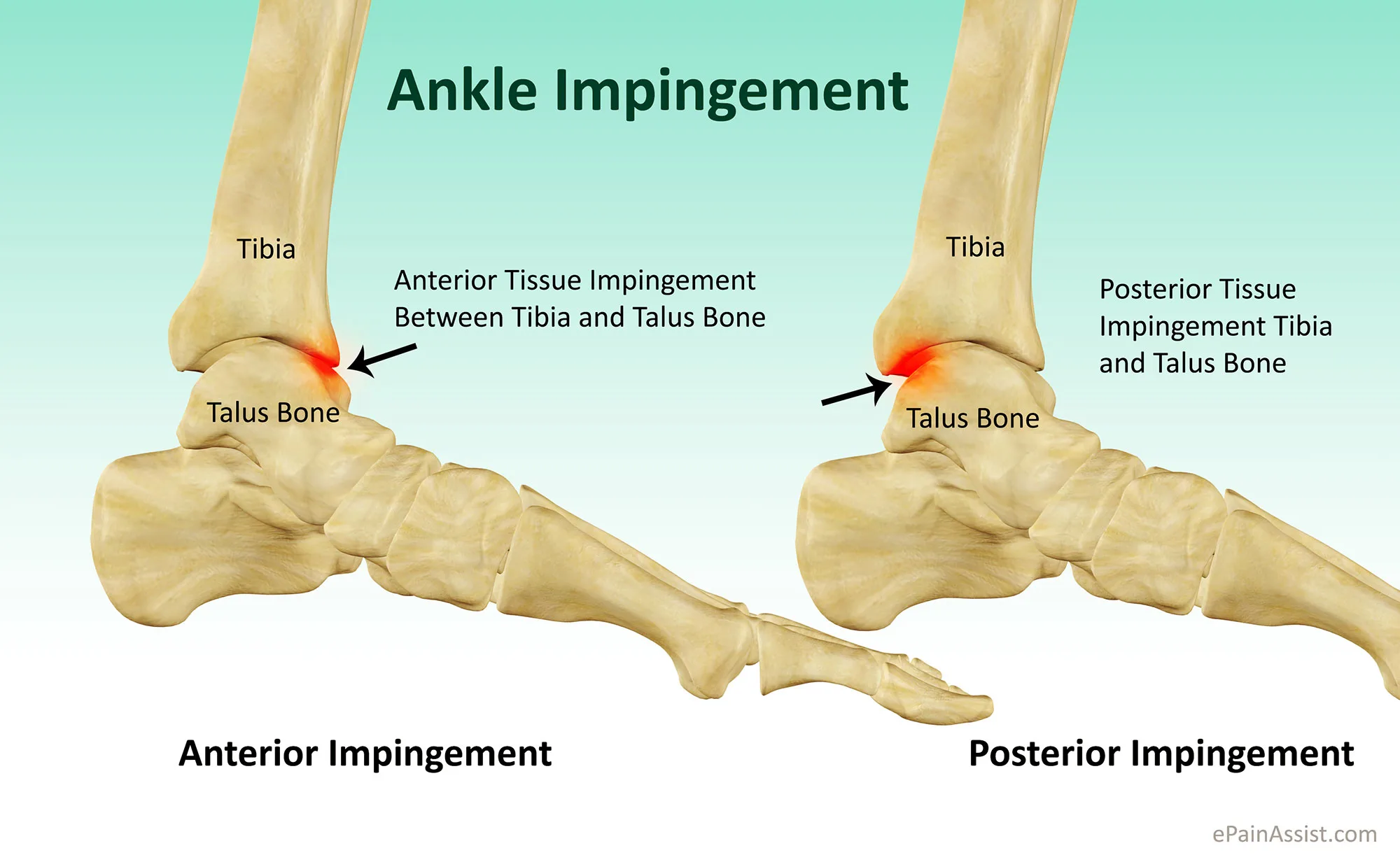 Anterior Ankle Impingement Book In At Podiatry Hq Clinics Today