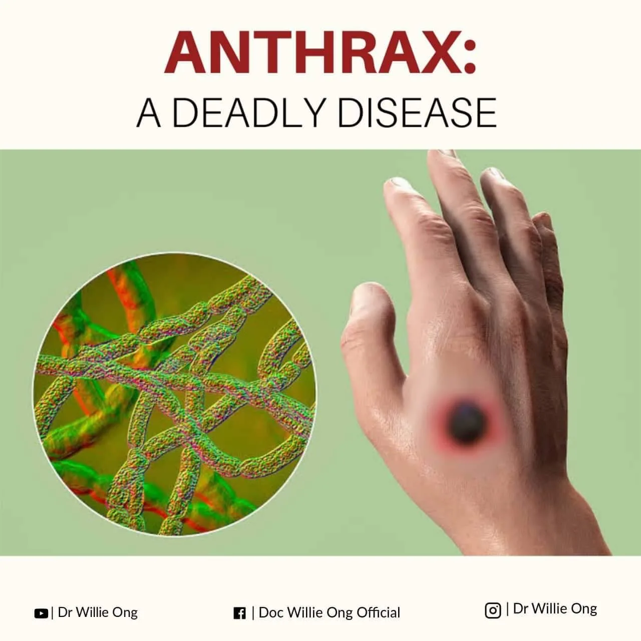 Anthrax A Deadly Disease Doc Willie Ong