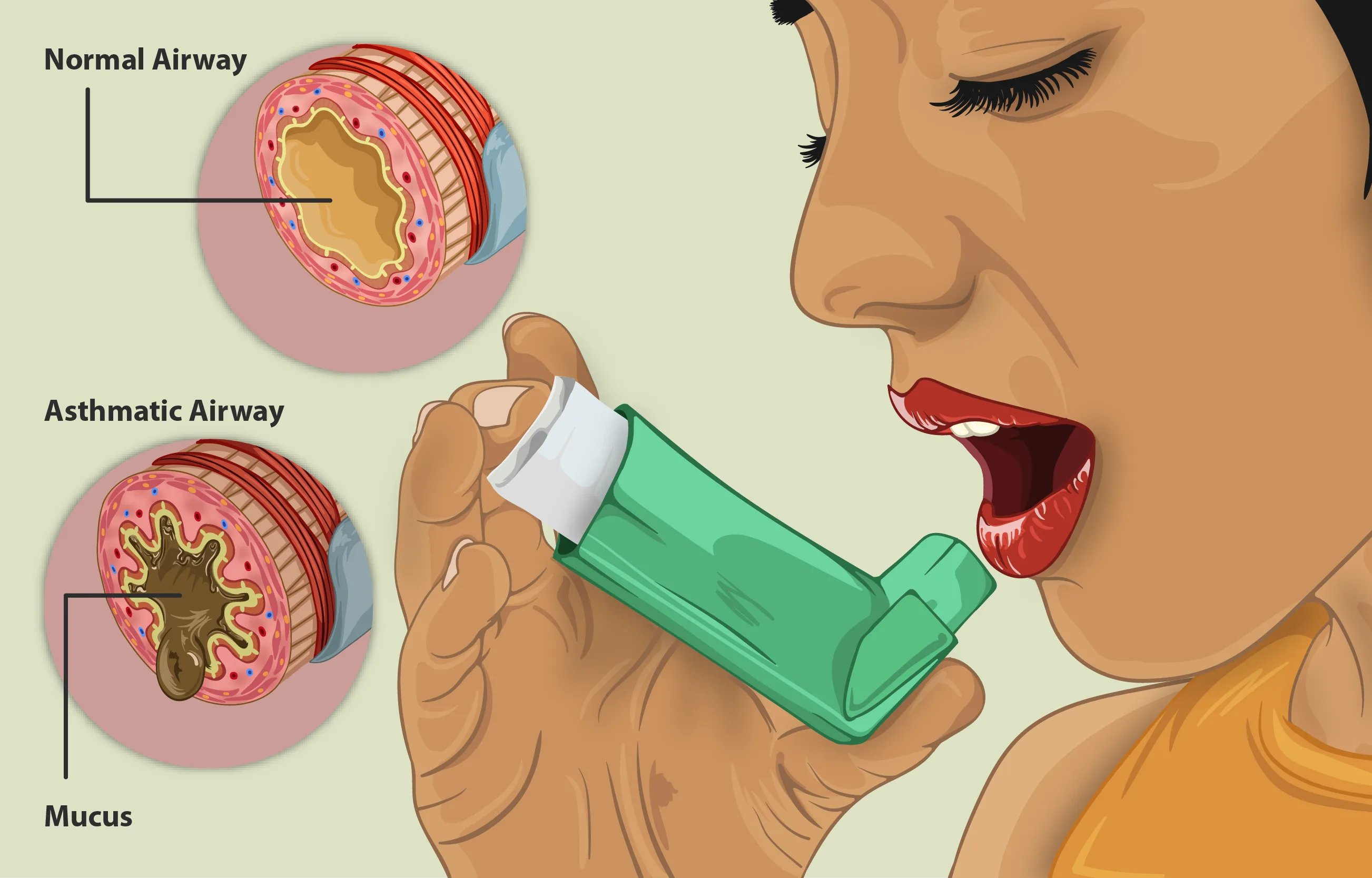 Asthma Causes Signs Symptoms And Treatment Medicus