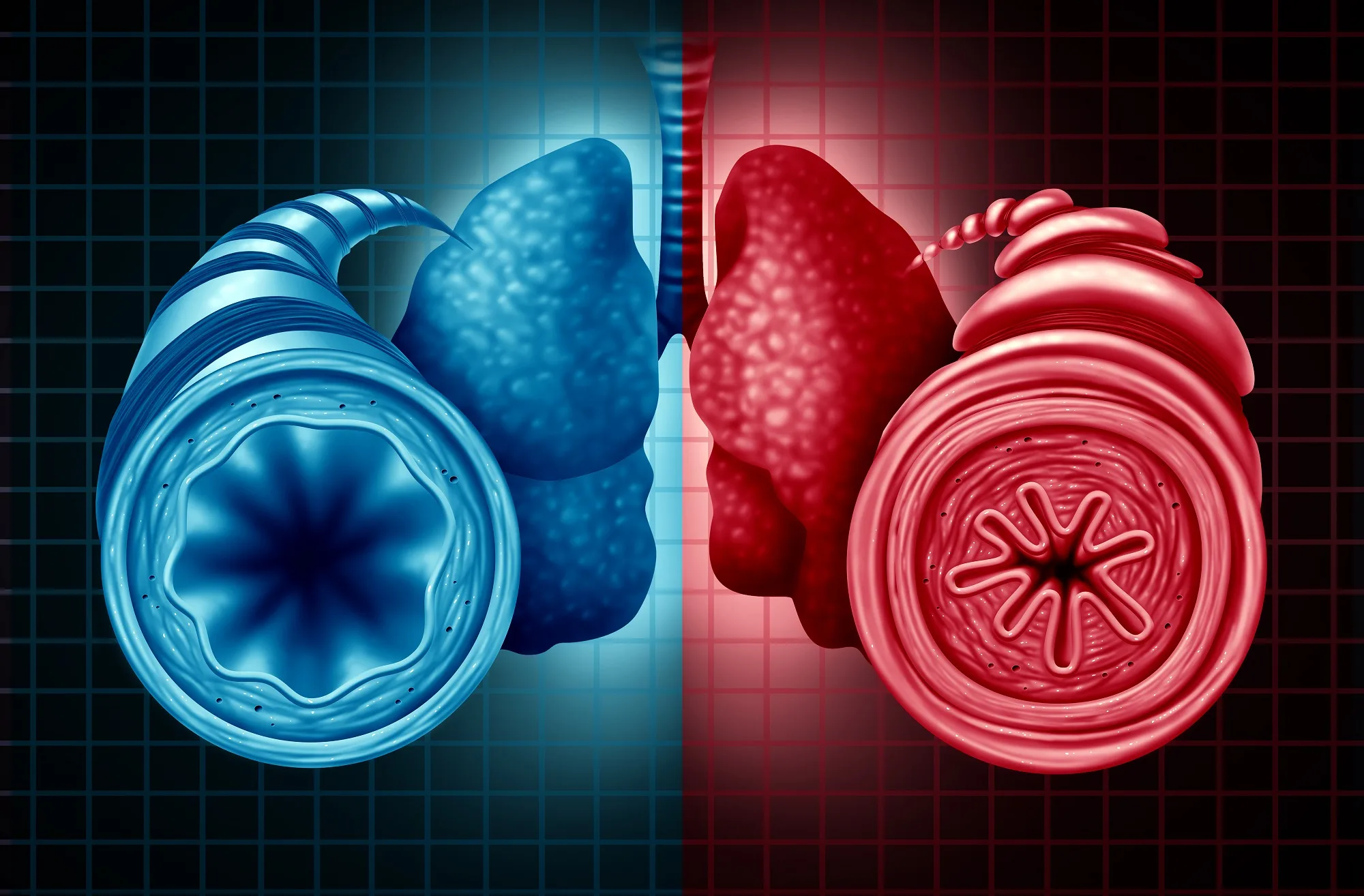 Asthma Exacerbation Treatment Failure Prevention During Step Down Therapy Pulmonology Advisor
