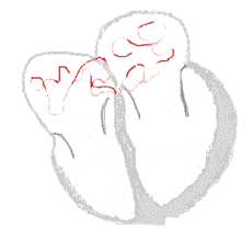 Atrial Fibrillation Pathophysiology Wikidoc