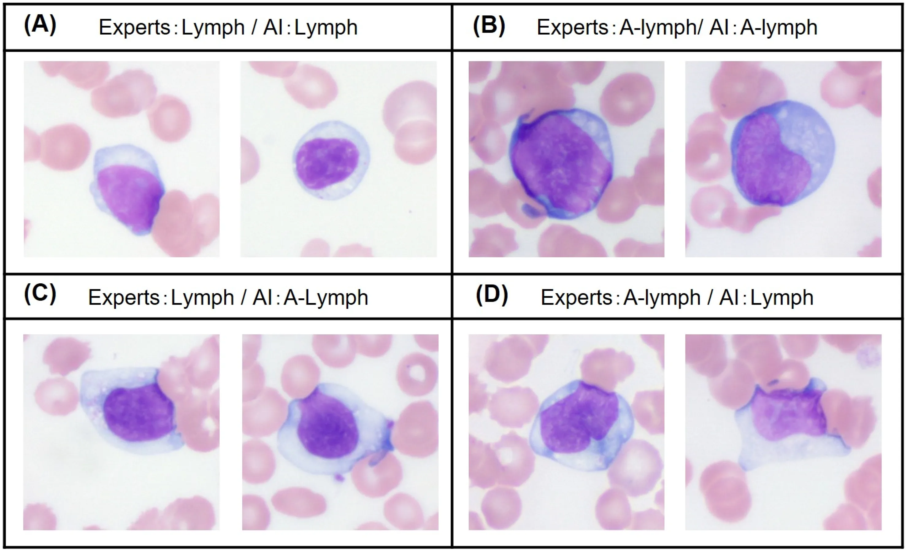 Atypical Lymphocyte