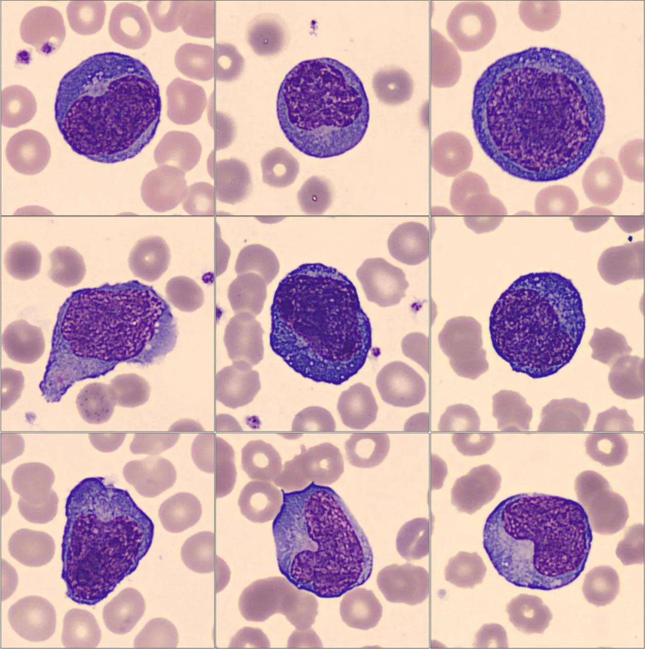 Atypical Lymphocyte