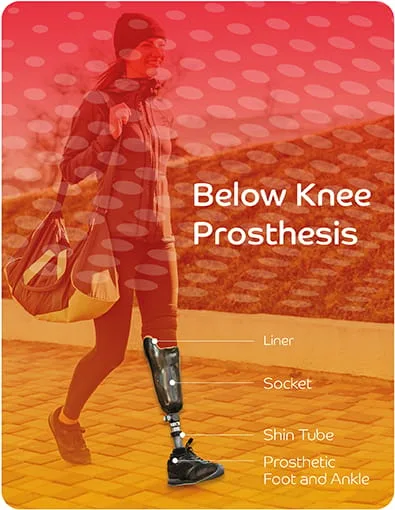 Below Knee Prosthetics
