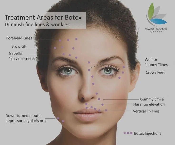 Botox Injection Sites Face Diagram Botox Cosmetic Botox Botox Riset