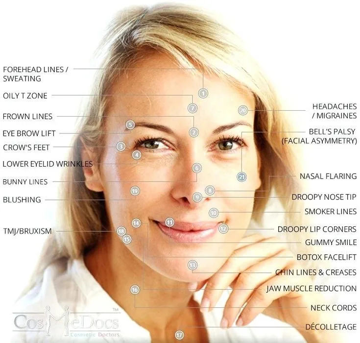 Botox Injection Sites Face Diagram Botox Face Diagram Inject