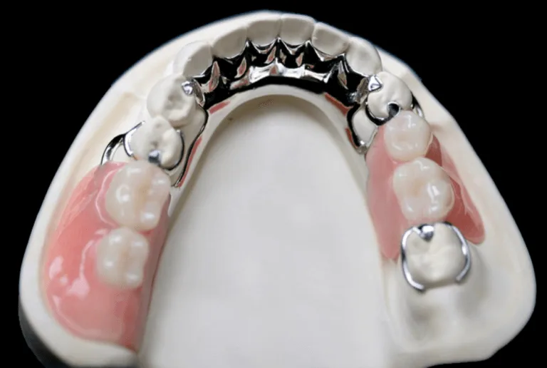 Cast Partial Denture In Toronto Atlas Dental
