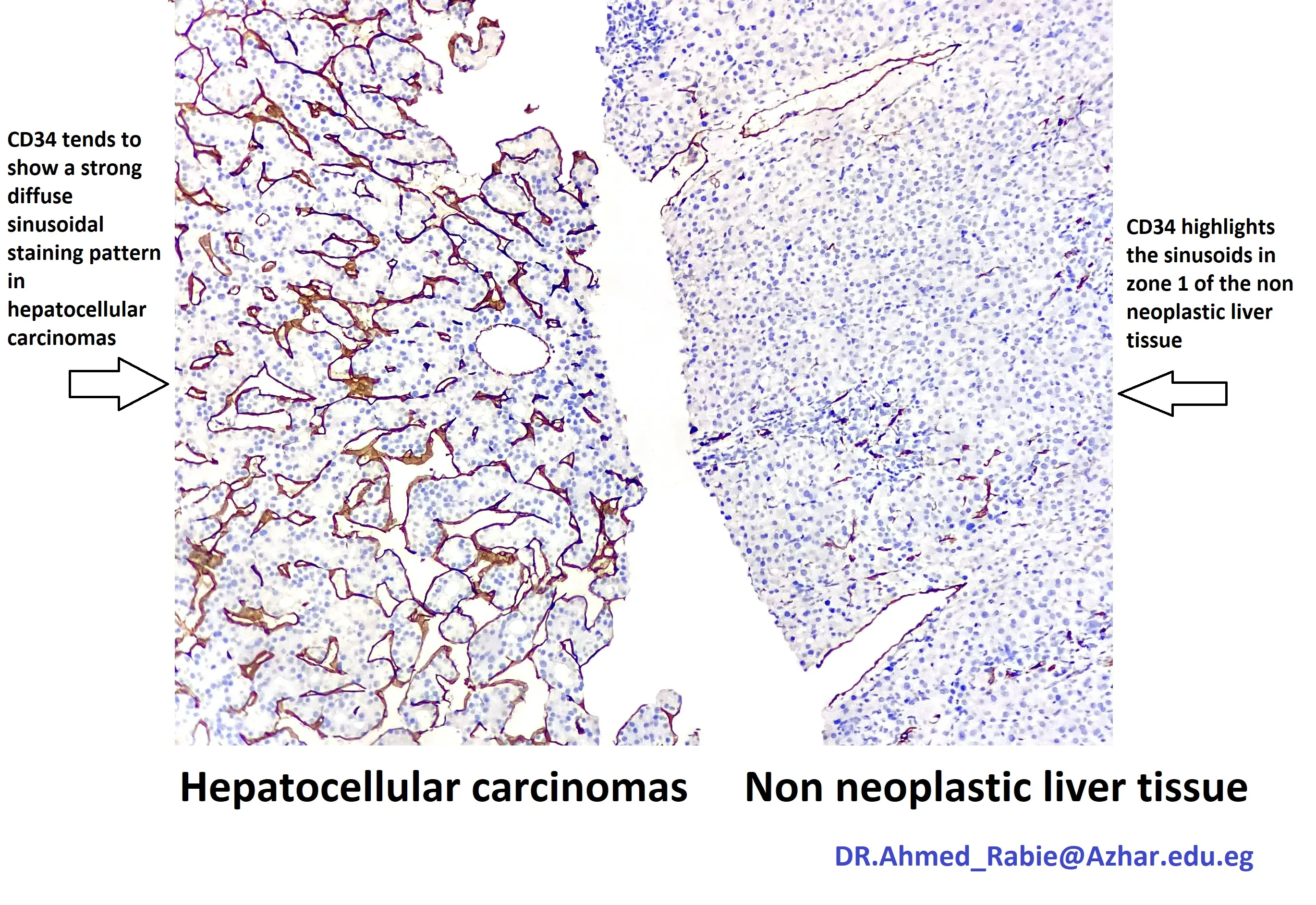 Cd34 Ihc In Hepatocellular Carcinoma And Non Neoplastic Liver Tissue Kiko Xp