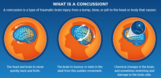 Concussion Signs And Symptoms Prevention Mary Donahue