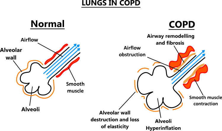 Diagram Diagram Of Lung Copd
