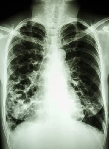 Diagram Diagram Of Lung Copd
