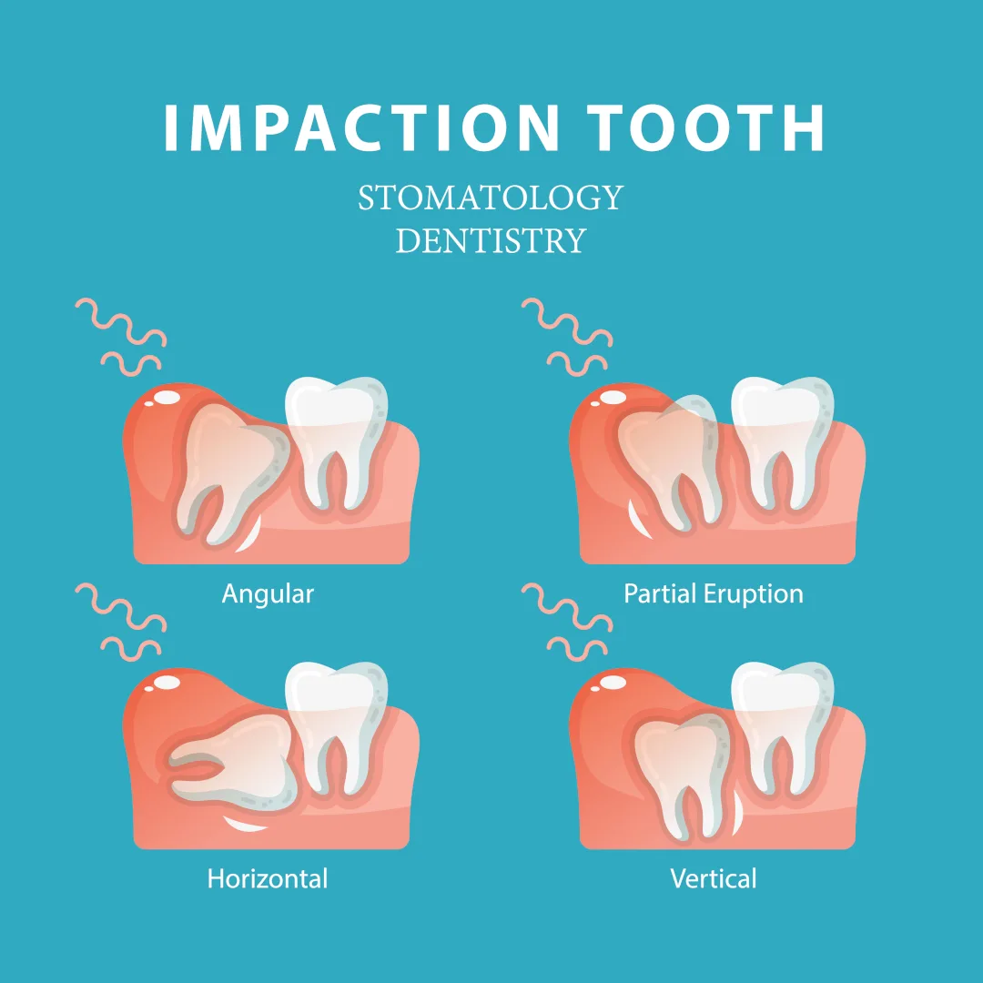 Diagram Fecal Impaction Diagram