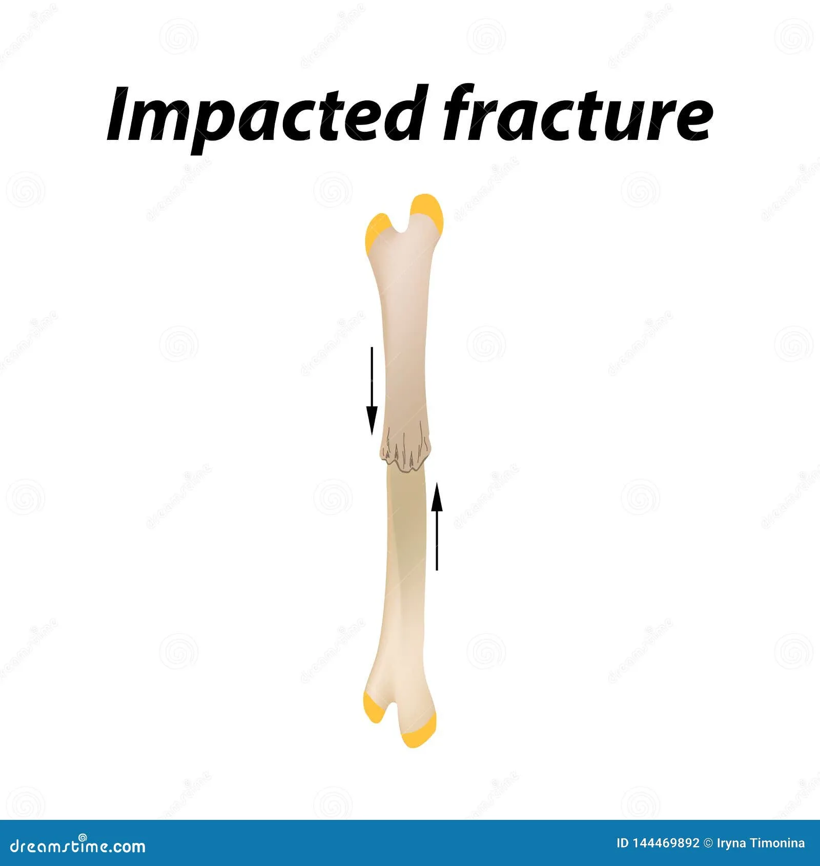 Diagram Fecal Impaction Diagram