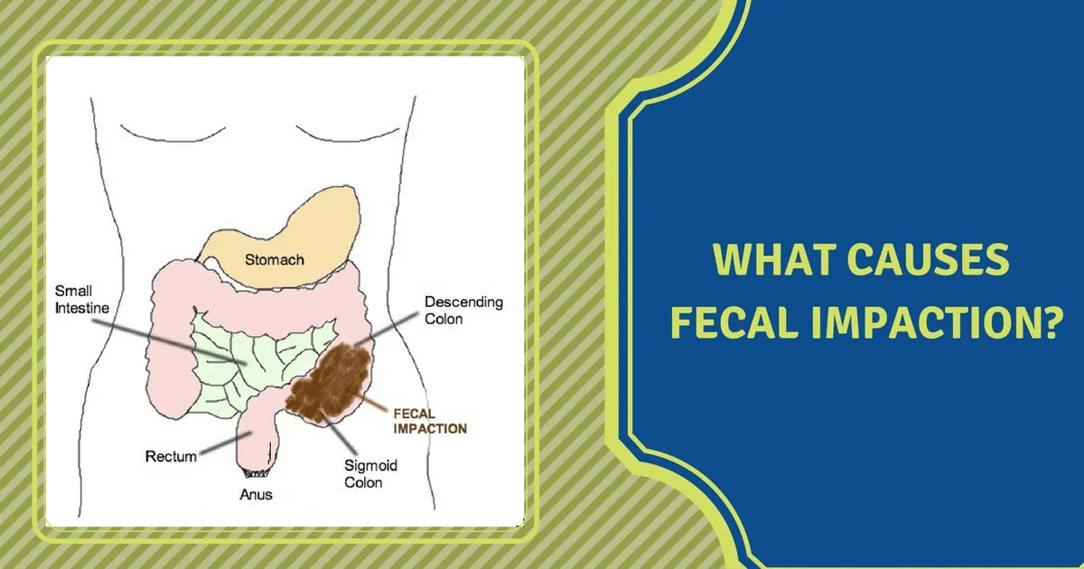 Diagram Fecal Impaction Diagram