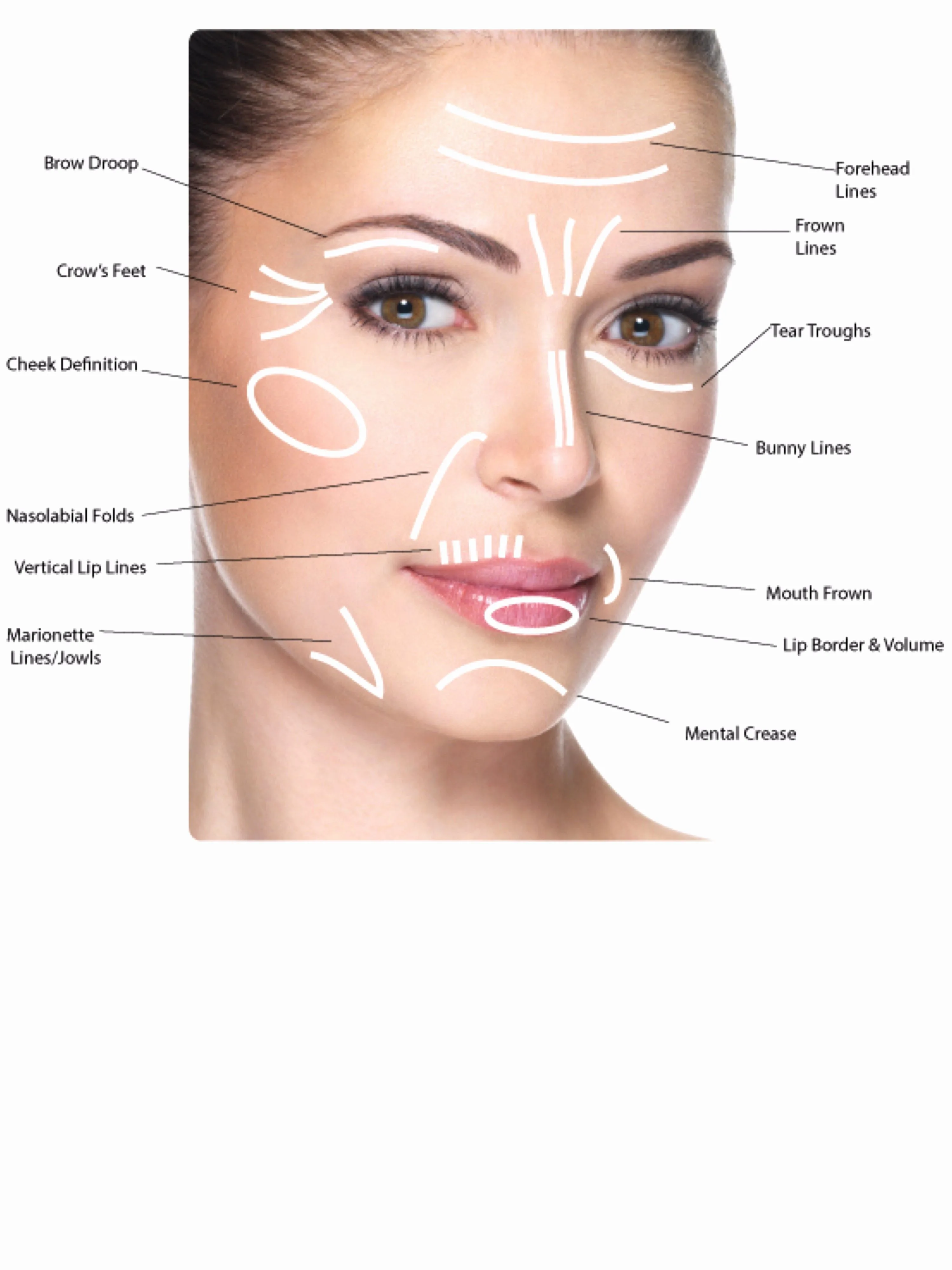 Diagram Of Botox Injection Sites Botox Injection Sites For M