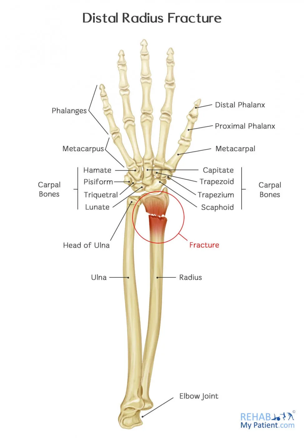 Distal Radius Fracture Rehab My Patient