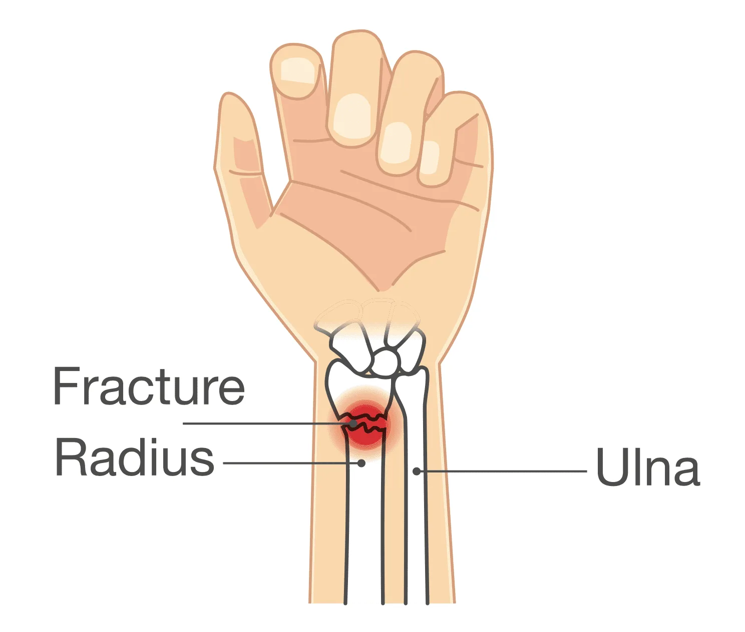 Distal Radius Fractures Upswing Health