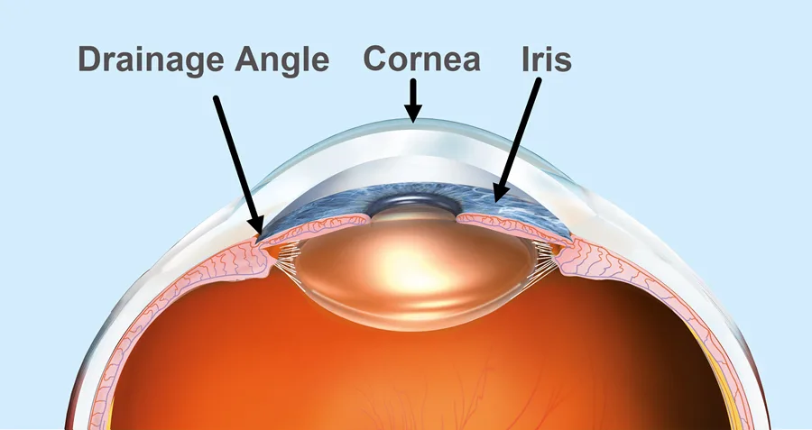 Drainage Angle Eye Patient