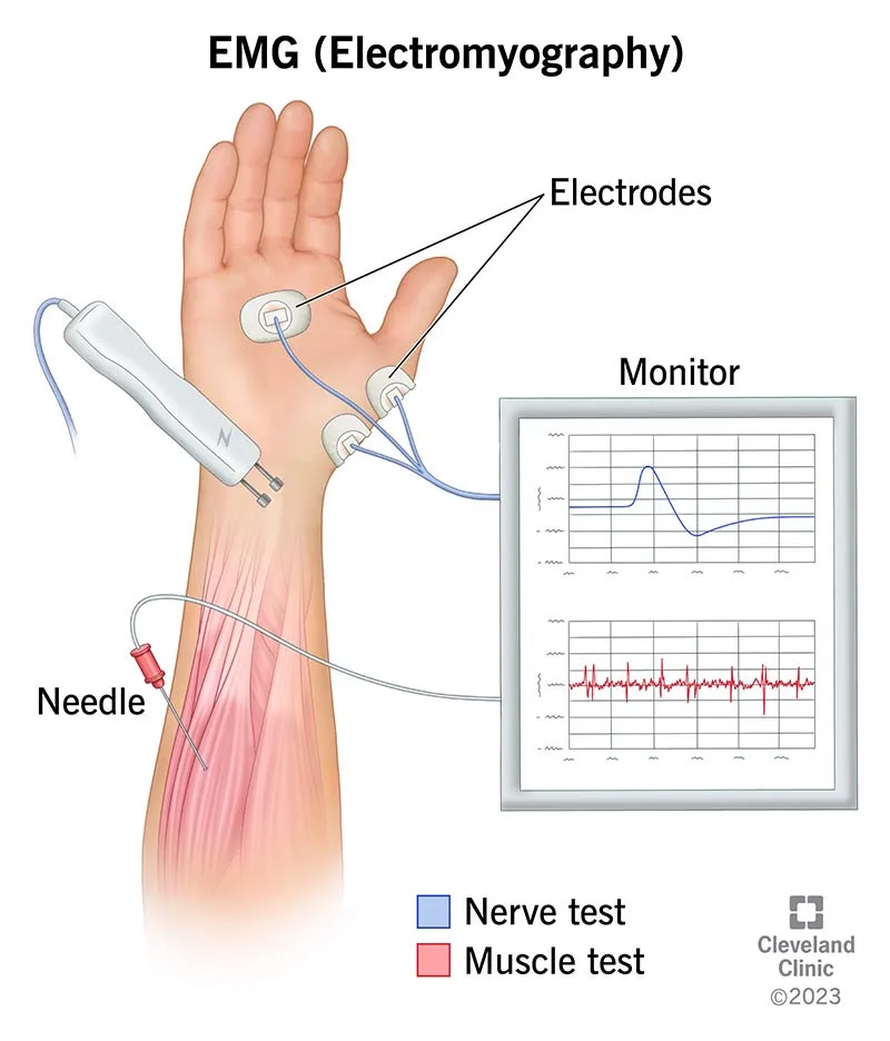 Emg Electromyography What It Is Purpose Procedure Results
