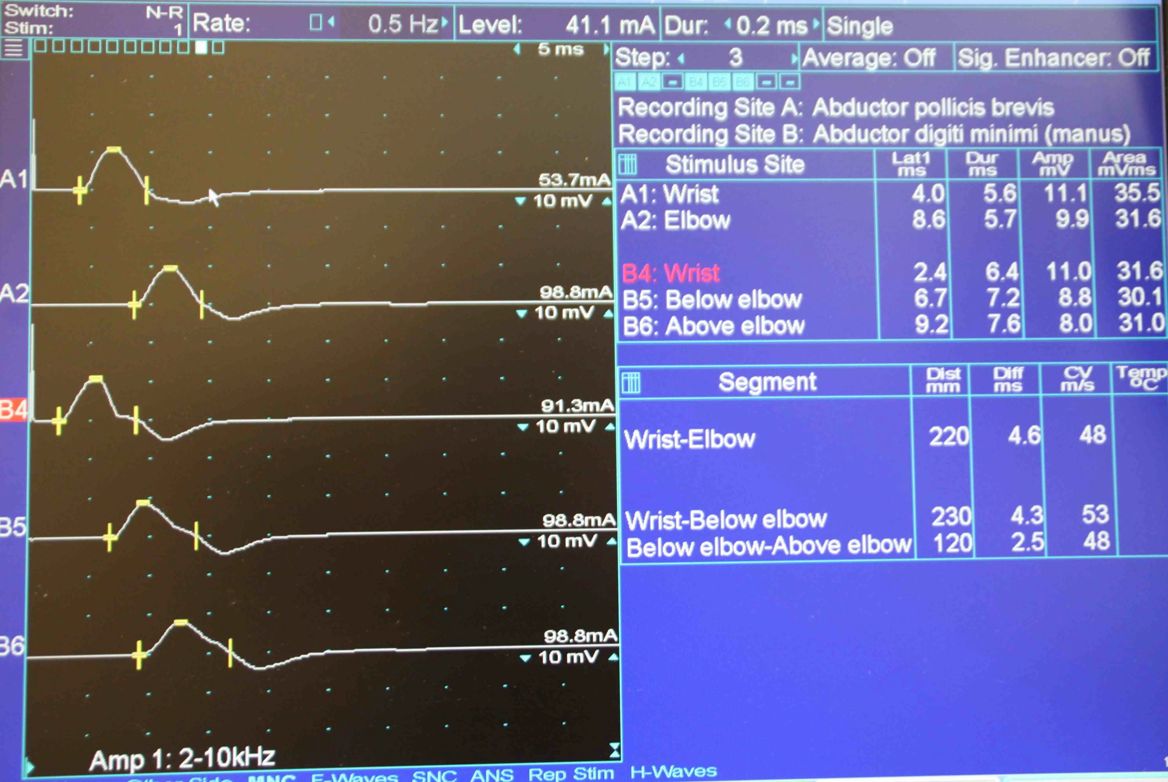 Emg Test Results