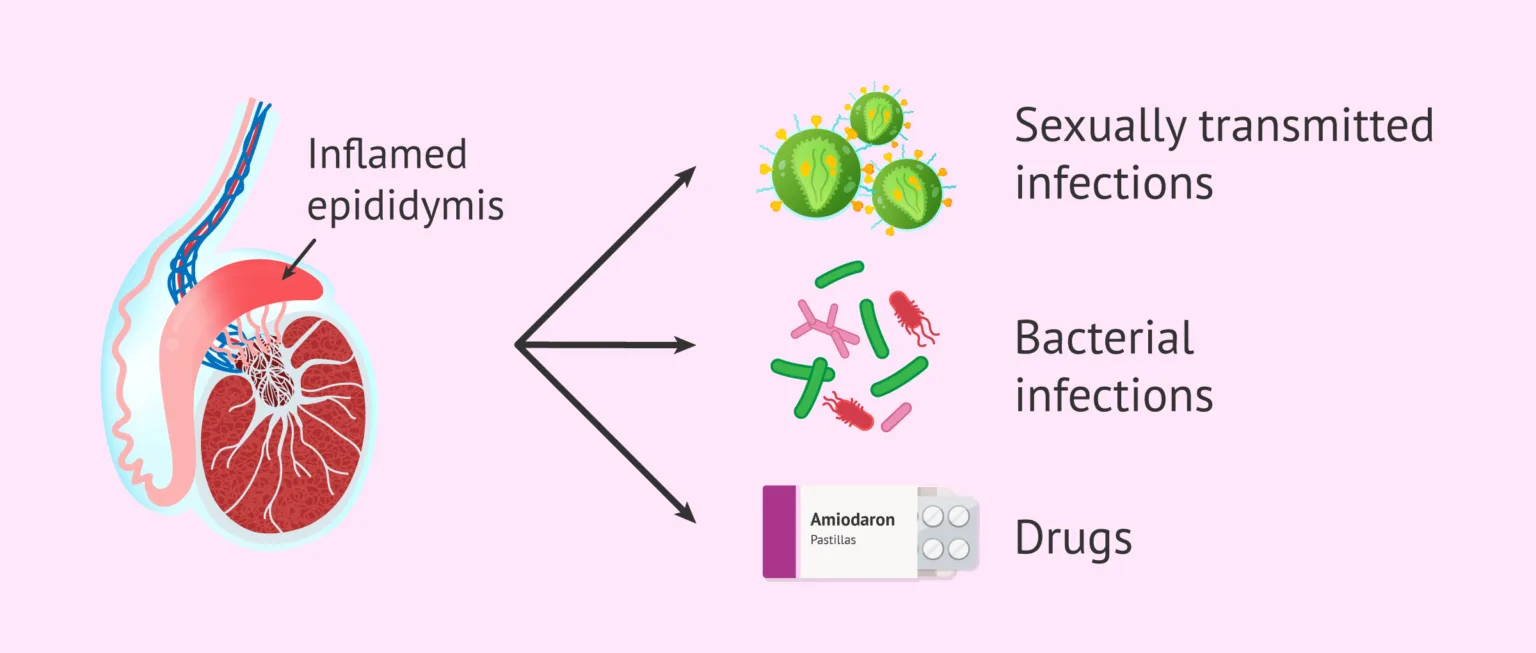 Epididymitis And Its Causes