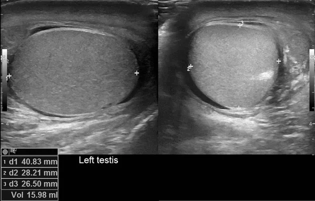 Epididymitis