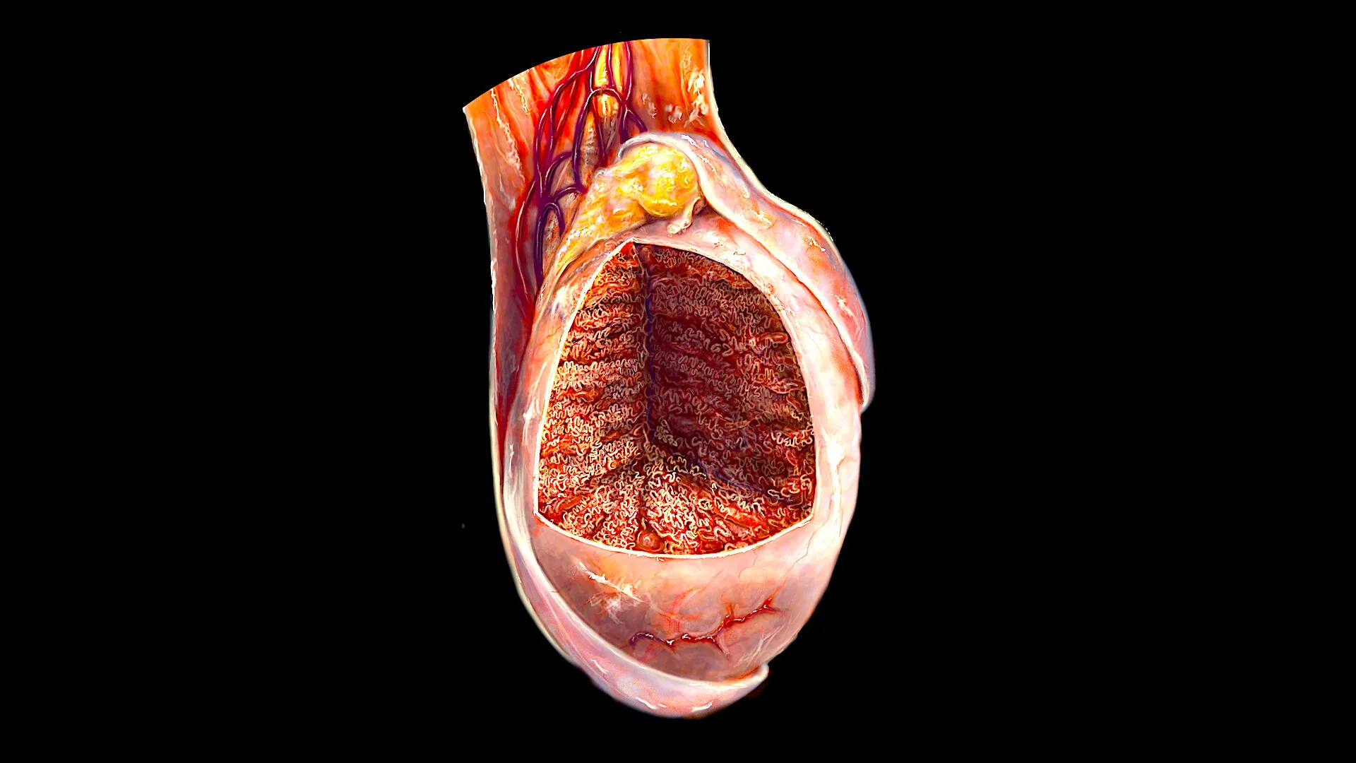 Epididymitis Lump