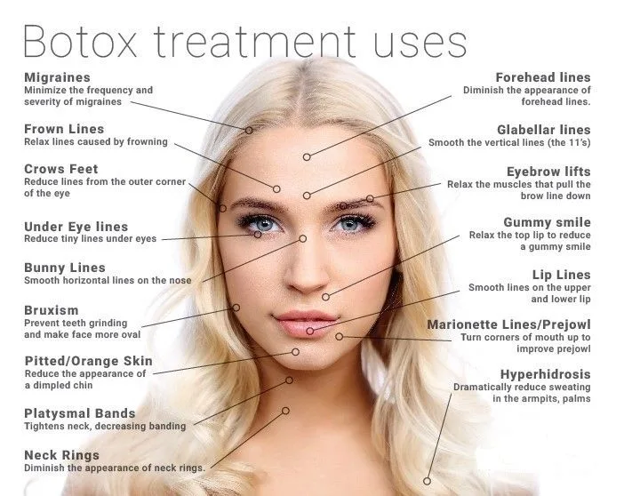 Face Diagram For Botox Injection