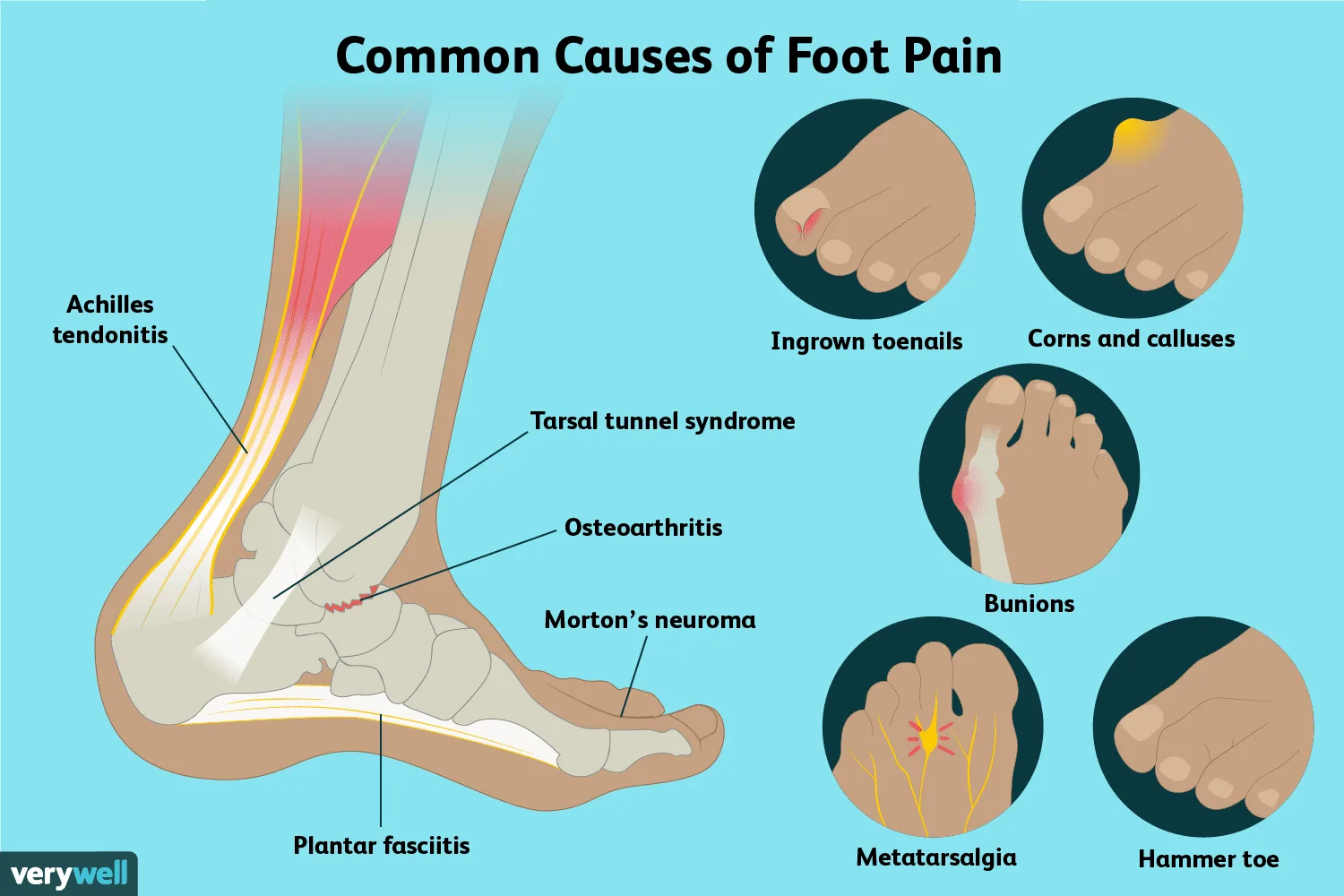Foot Anatomy Bones Joints And Causes Of Pain