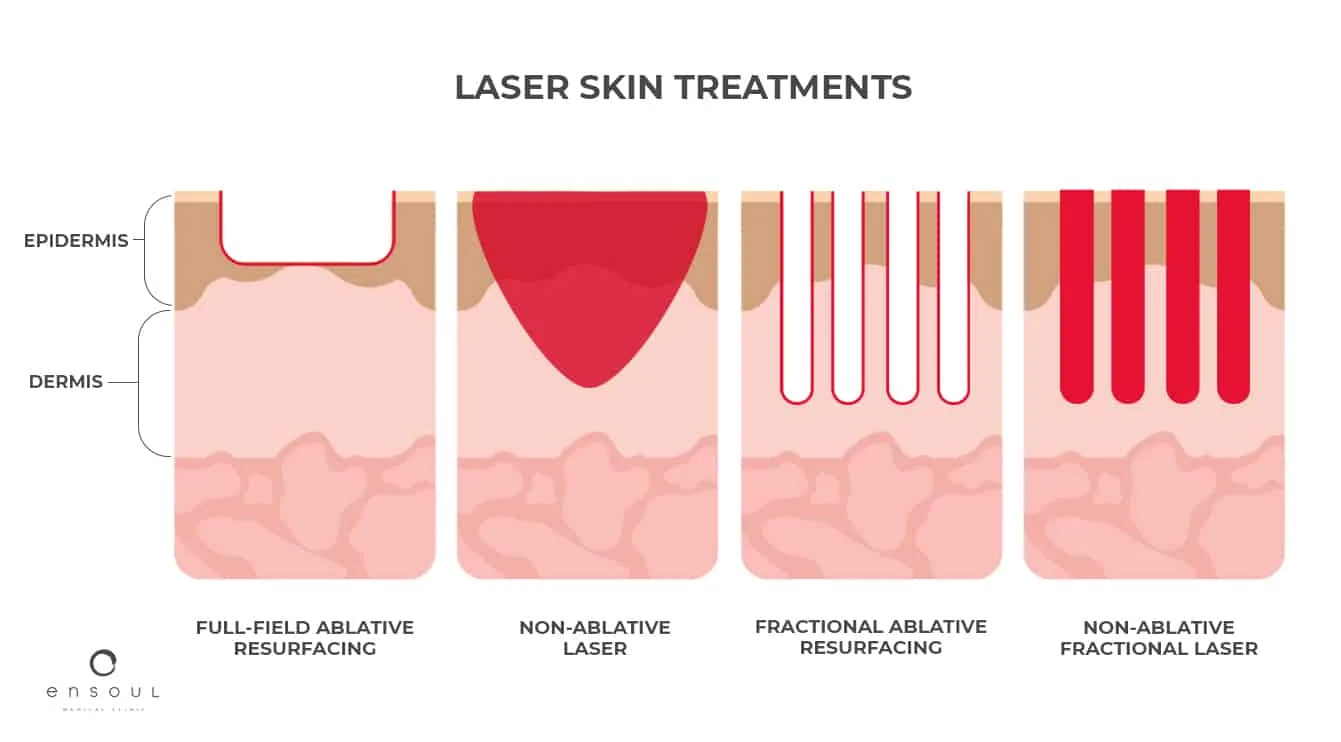 Fractional Laser