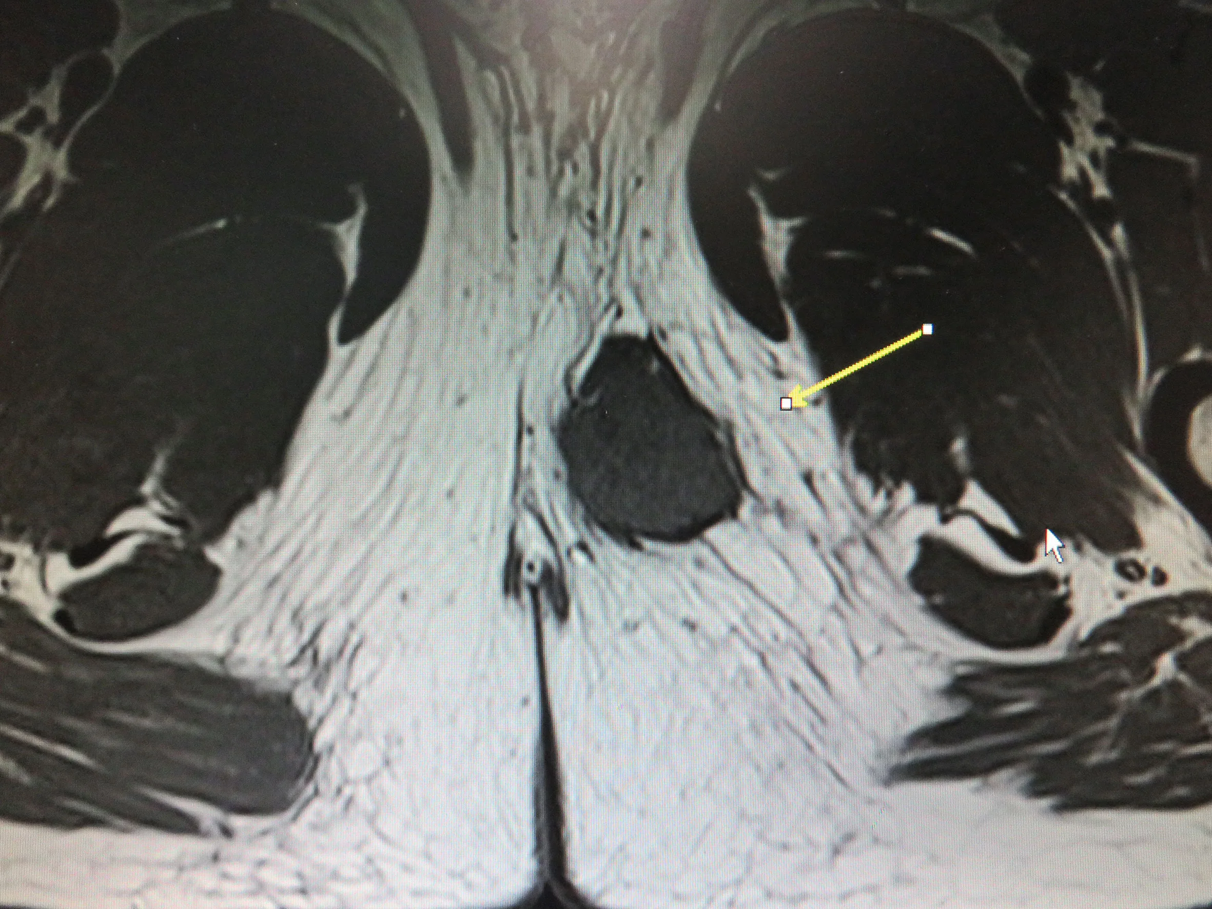 Frontiers Proximal Type Epithelioid Sarcoma Of The Perineum A Case Report And Literature Review