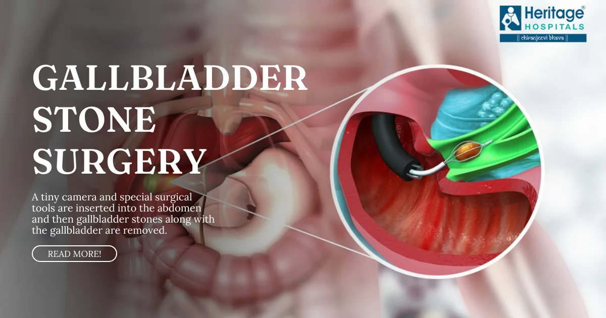 Gallbladder Stone Laparoscopic Surgery Heritage Hospitals Heritage Hospitals