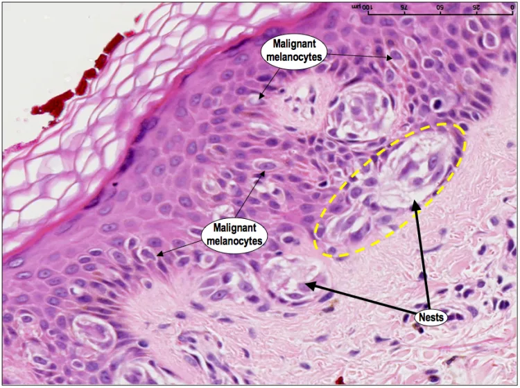 Histoquarterly Superficial Spreading Malignant Melanoma Histology Blog