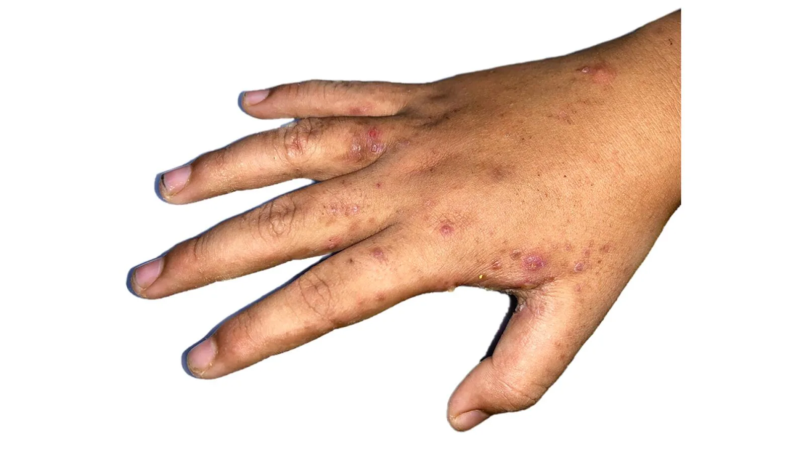 How To Identify Scabies Symptoms Pictures Causes And More