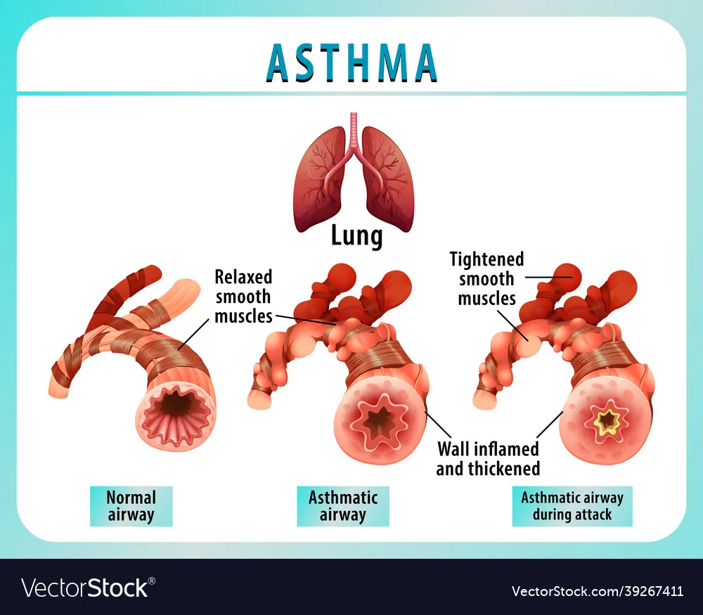 How To Know If You Have Bronchial Asthma At Glenn Barbee Blog