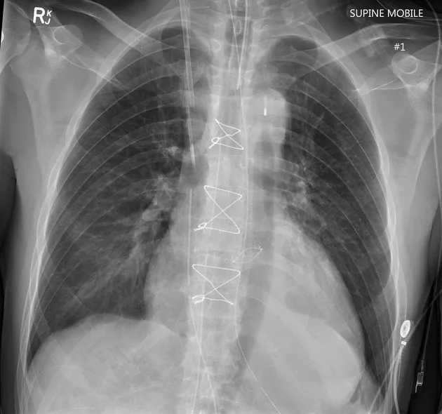 Intra Aortic Balloon Pump Xray