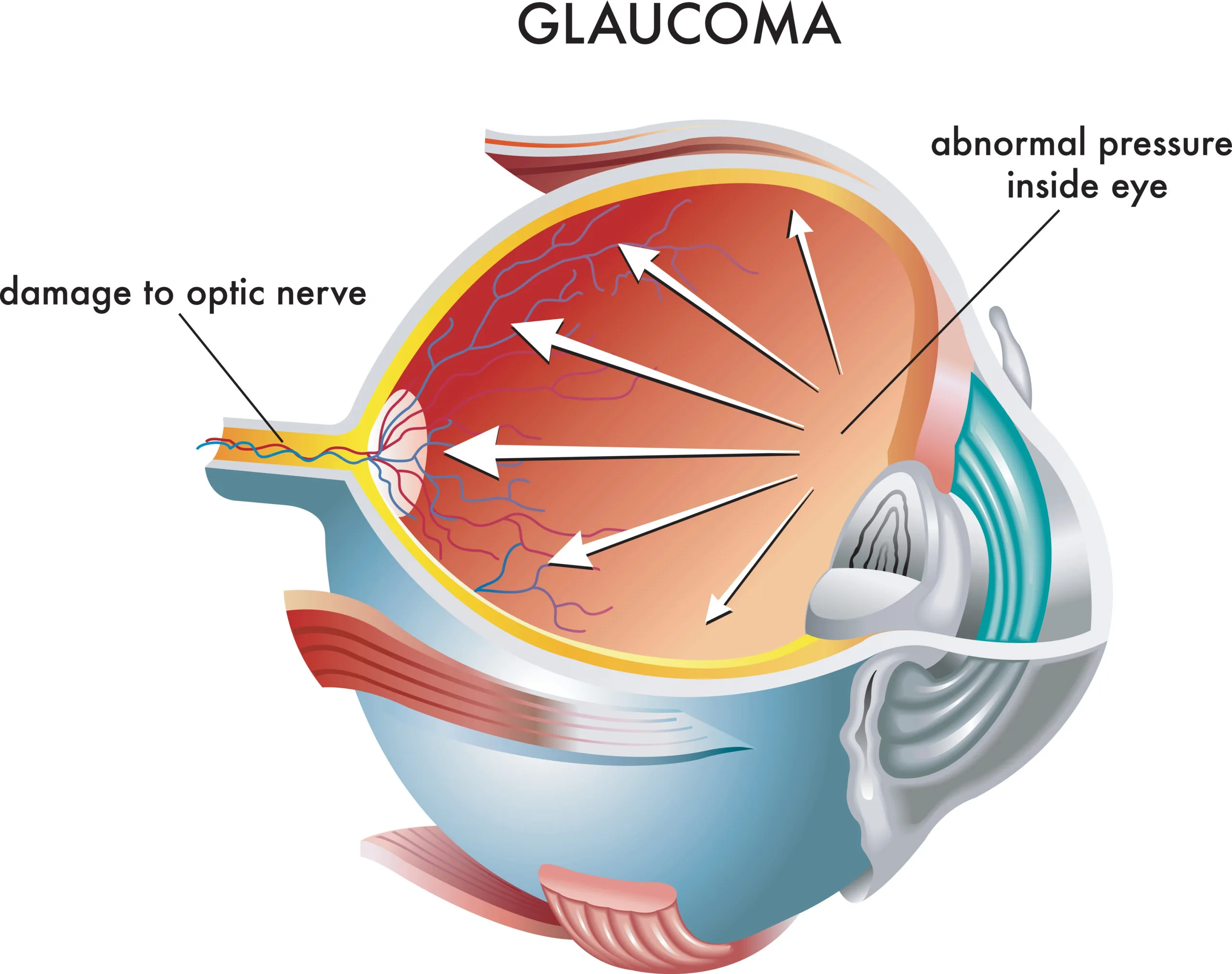 Intraocular Pressure And Retinal Nerve Fiber Layer Thinning In Glaucoma Docwire News