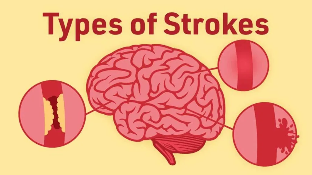 Most Common Type Of Stroke Revealed Discovery Body