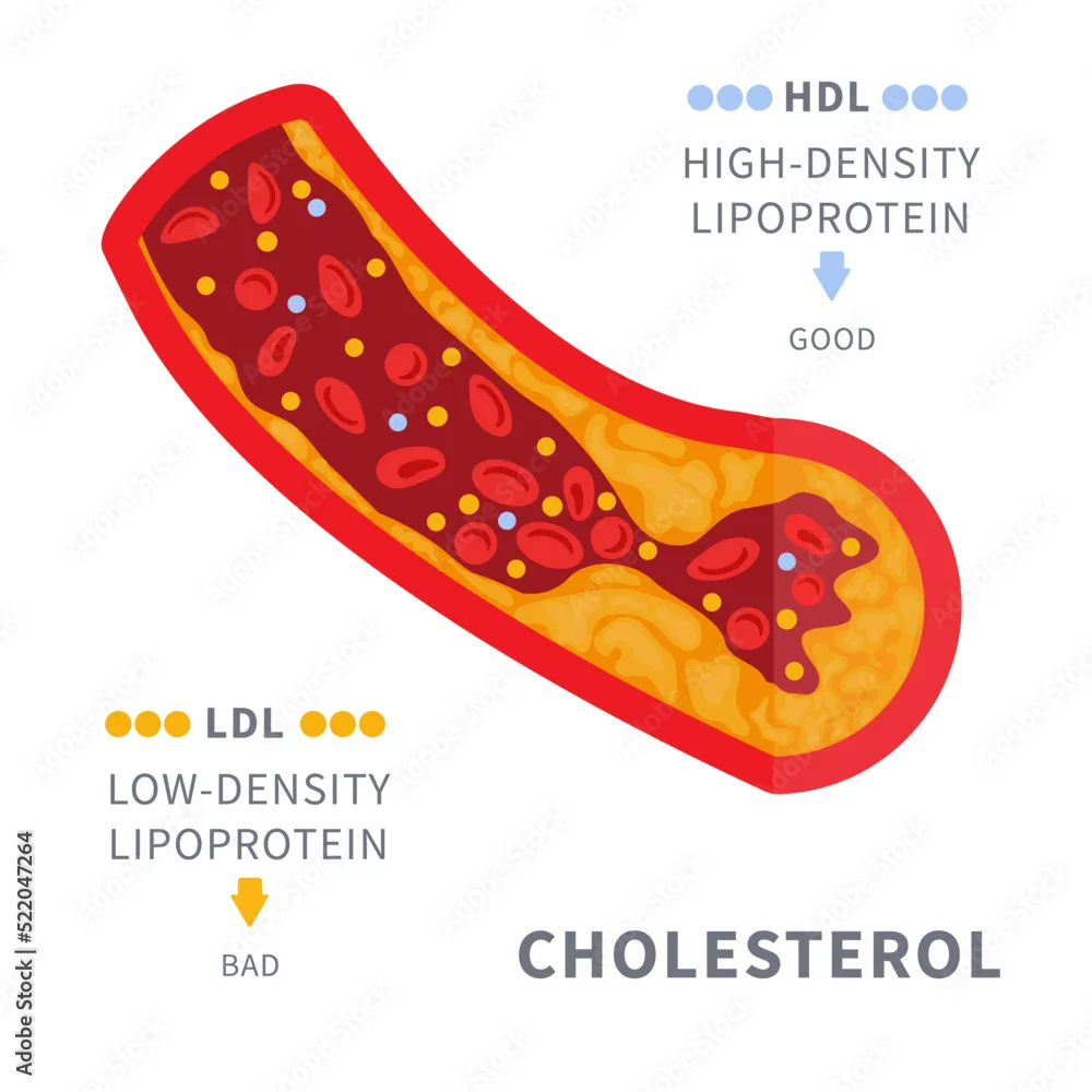 Narrowed Blood Vessel With Cholesterol Plaque Buildup Artery Blocked With A Fat Cells Clot Ldl