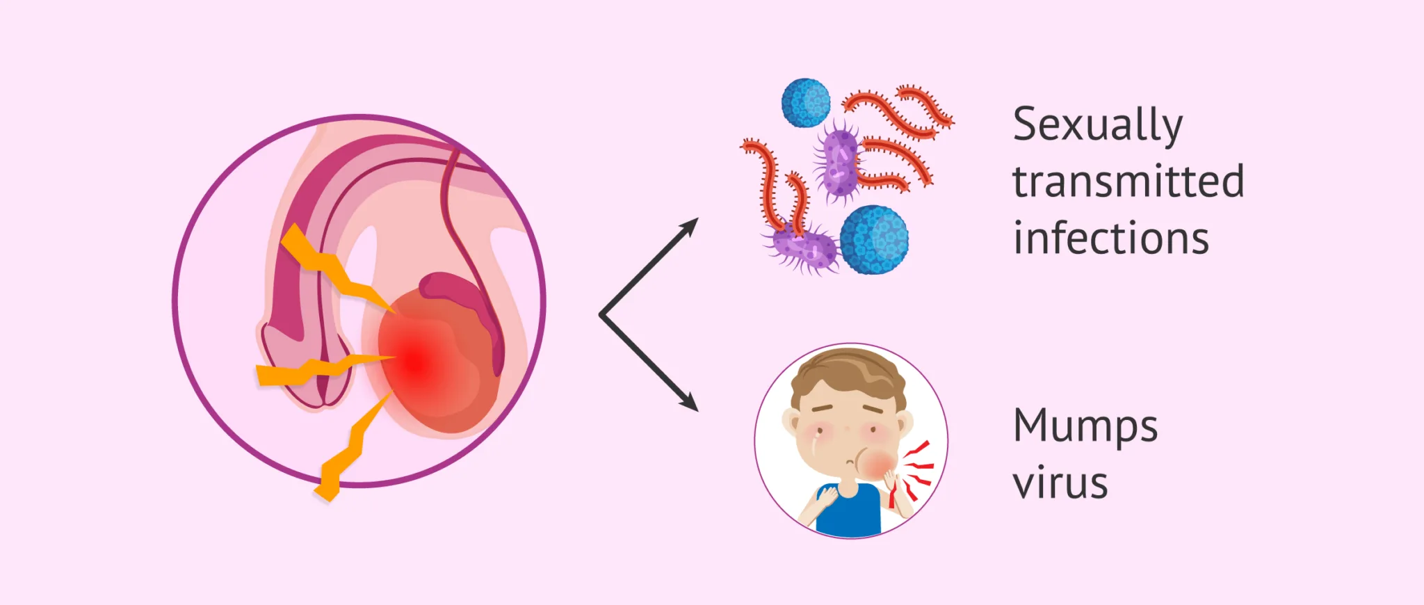Orchitis And Its Causes