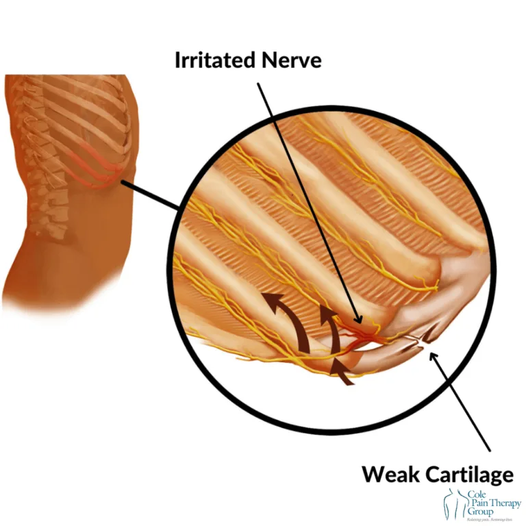 Pain Free Ribs How To Overcome Slipping Rib Syndrome Effectively Cole Pain Therapy Group