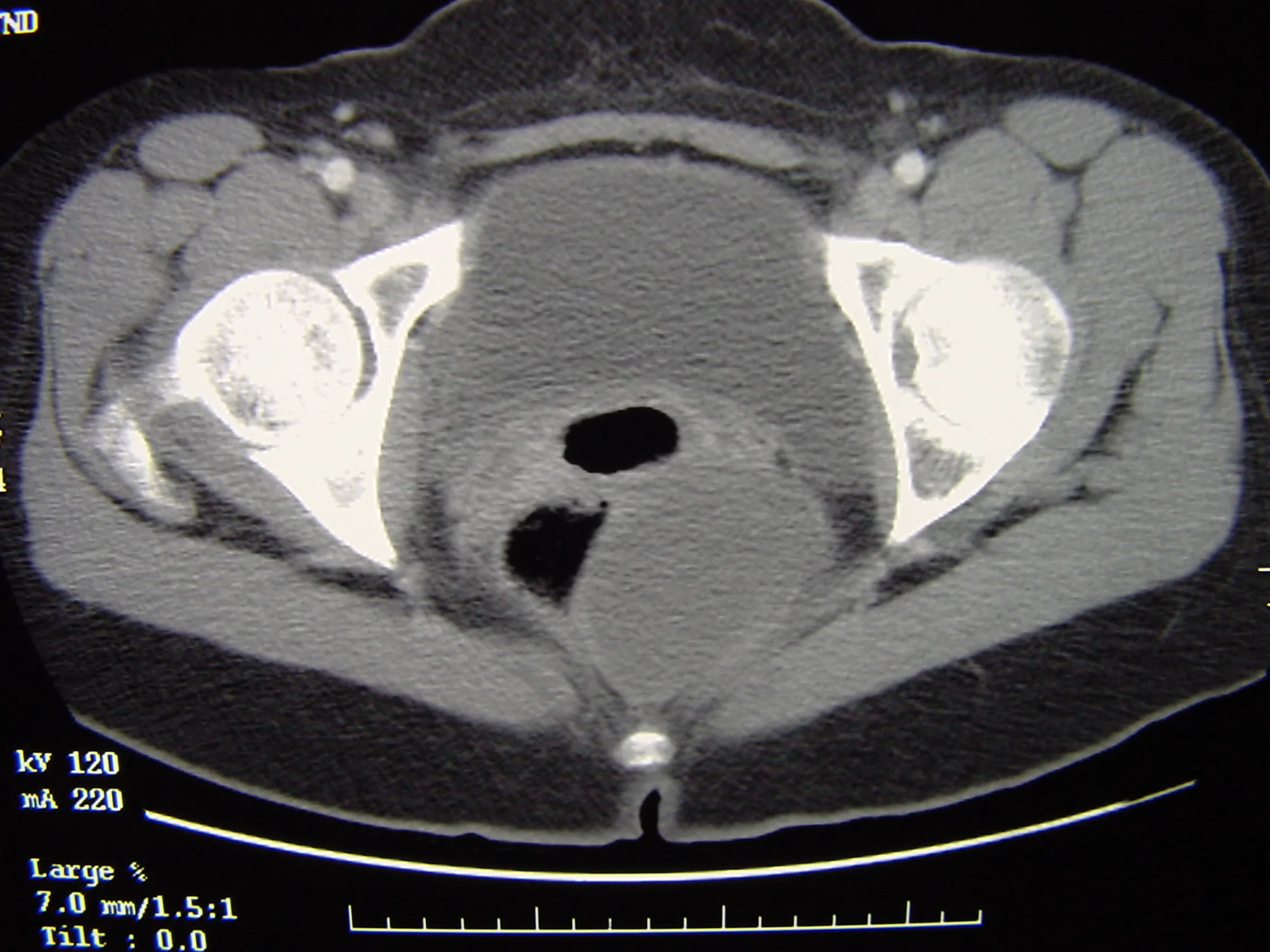 Perineum Cyst