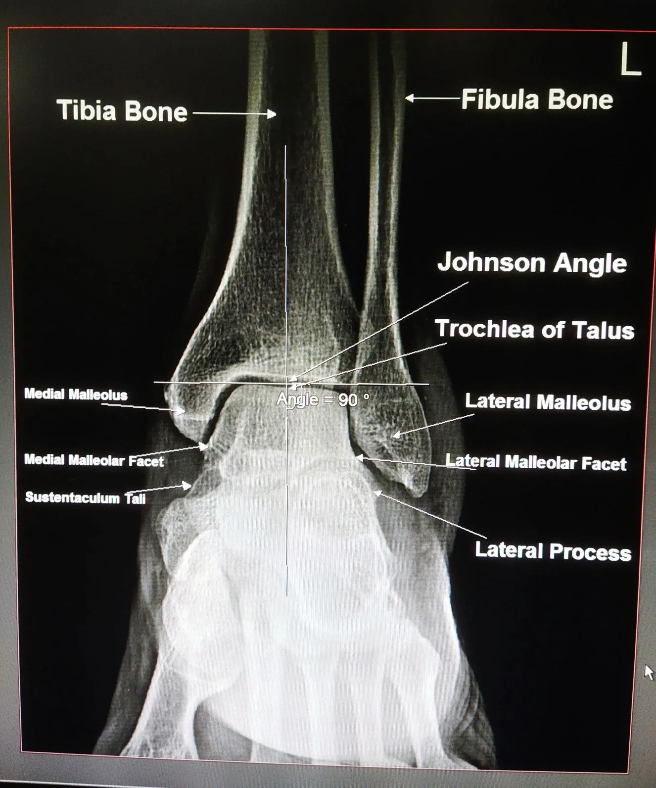 Pin On Ankle Joint Ap View Basic Anatomy