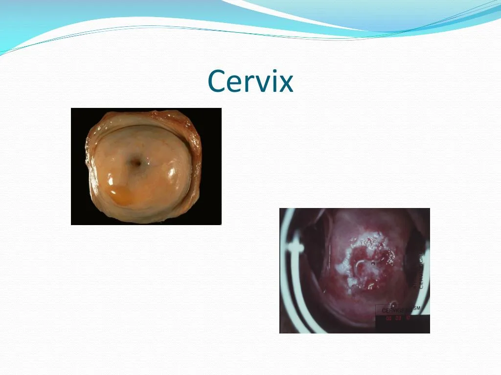 Ppt Save Your Cervix Powerpoint Presentation Free Download Id 2104684
