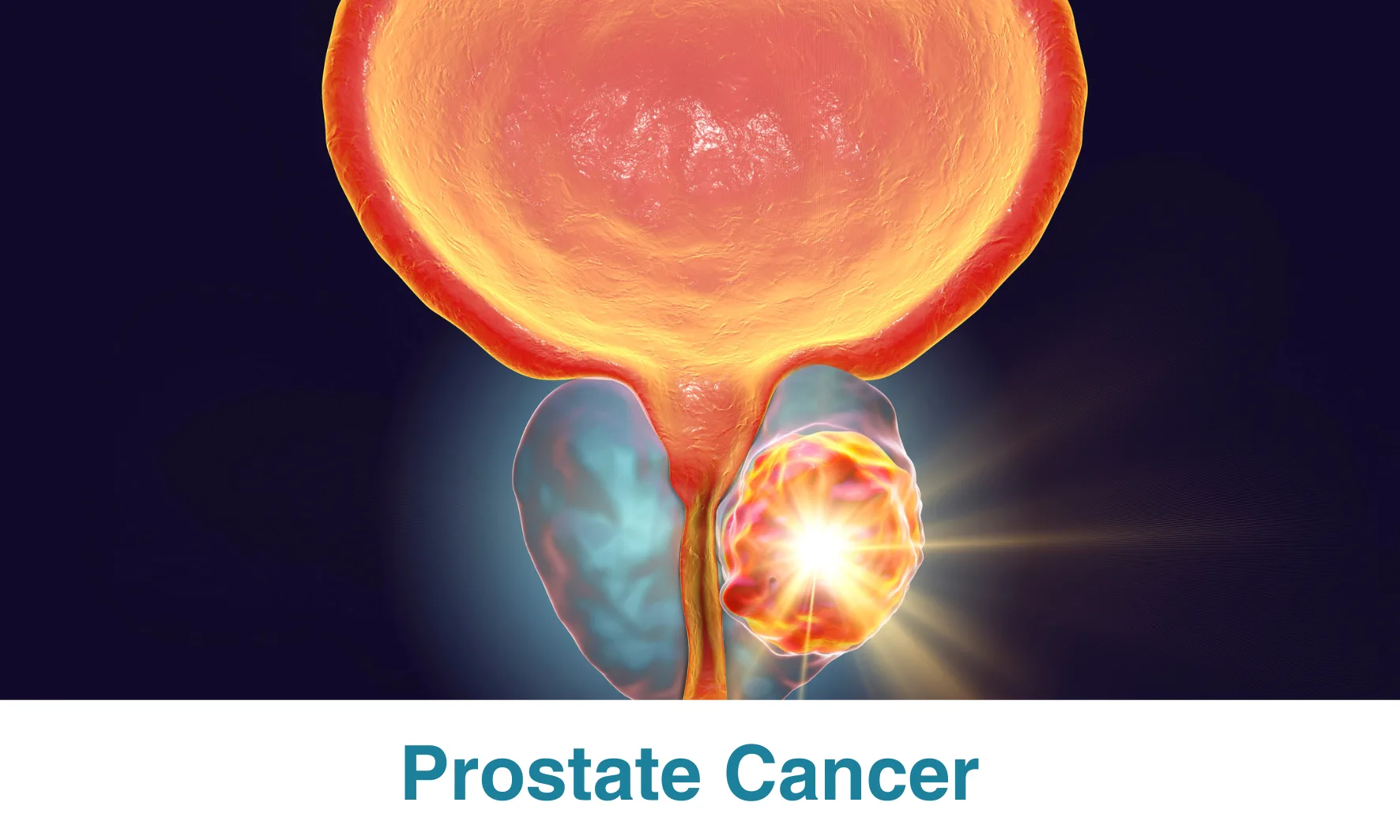 Prostate Cancer Comprehensive Guide Proton Therapy