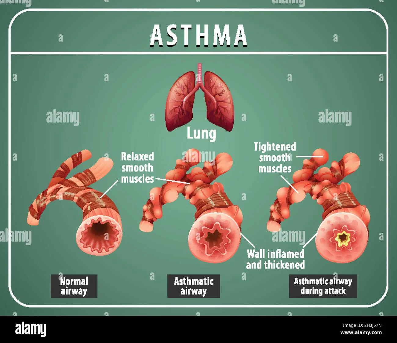 Role Of Chest X Ray In Asthma At Pearl Peterson Blog