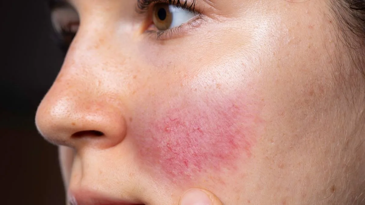 Rosacea Cos È E Come Trattarla Gvm News